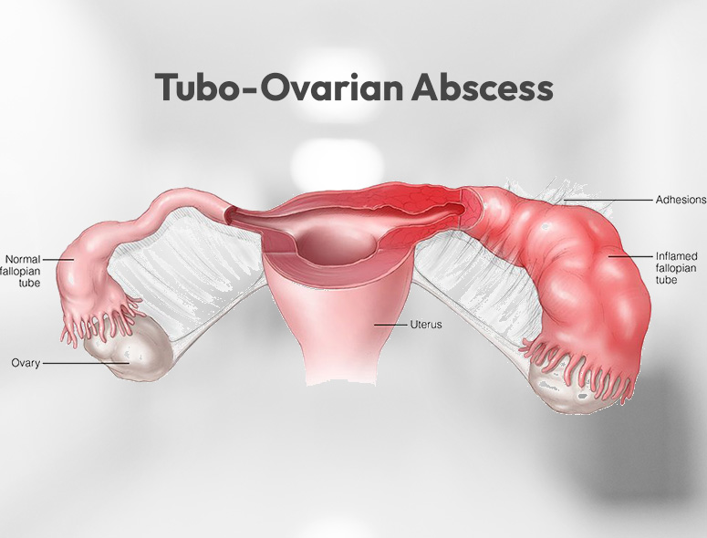 Pelvic Inflammatory Disease (PID) – Grover Gastro and Fertility Centre