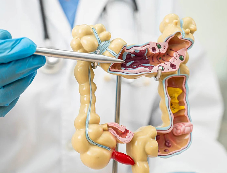 Colonic Cancer – Grover Gastro and Fertility Centre
