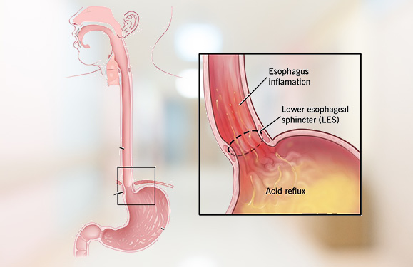 Gastroesophageal Reflux Disease (GERD)