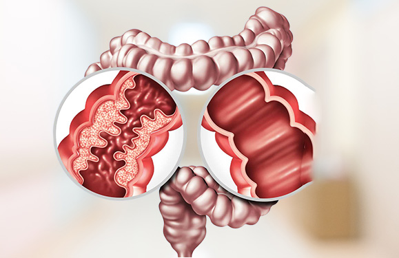 Inflammatory Bowel Disease (IBD)