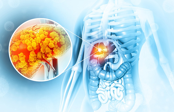 Liver Cirrhosis