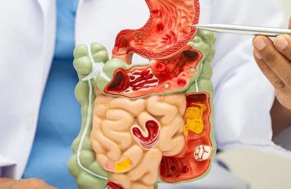 GI Bleeding